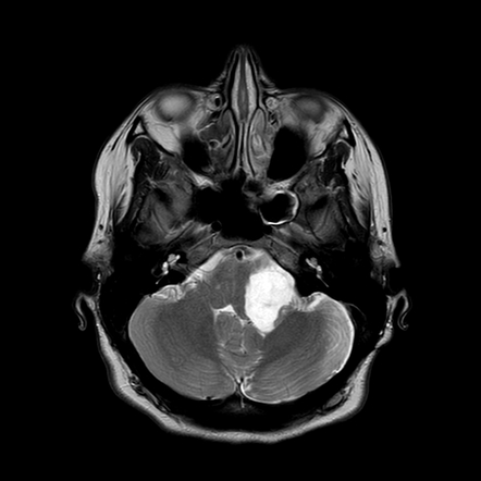 Epidermoid cyst | Image | Radiopaedia.org