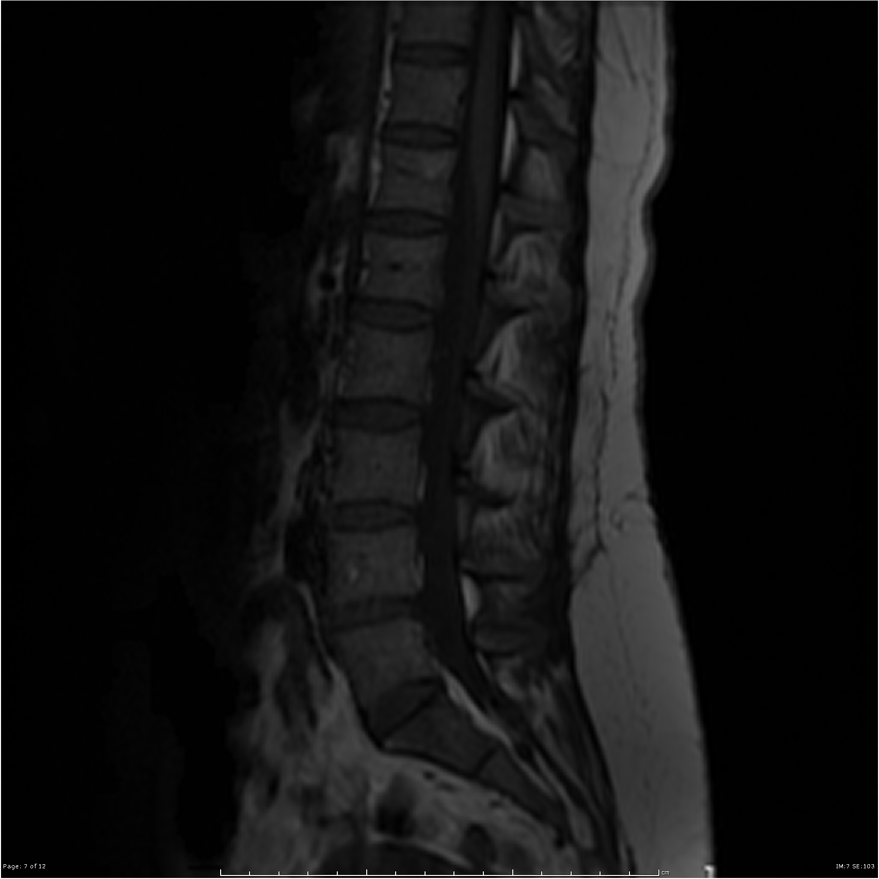 L4/5 left paracentral disc extrusion with left L5 and S1 nerve root ...