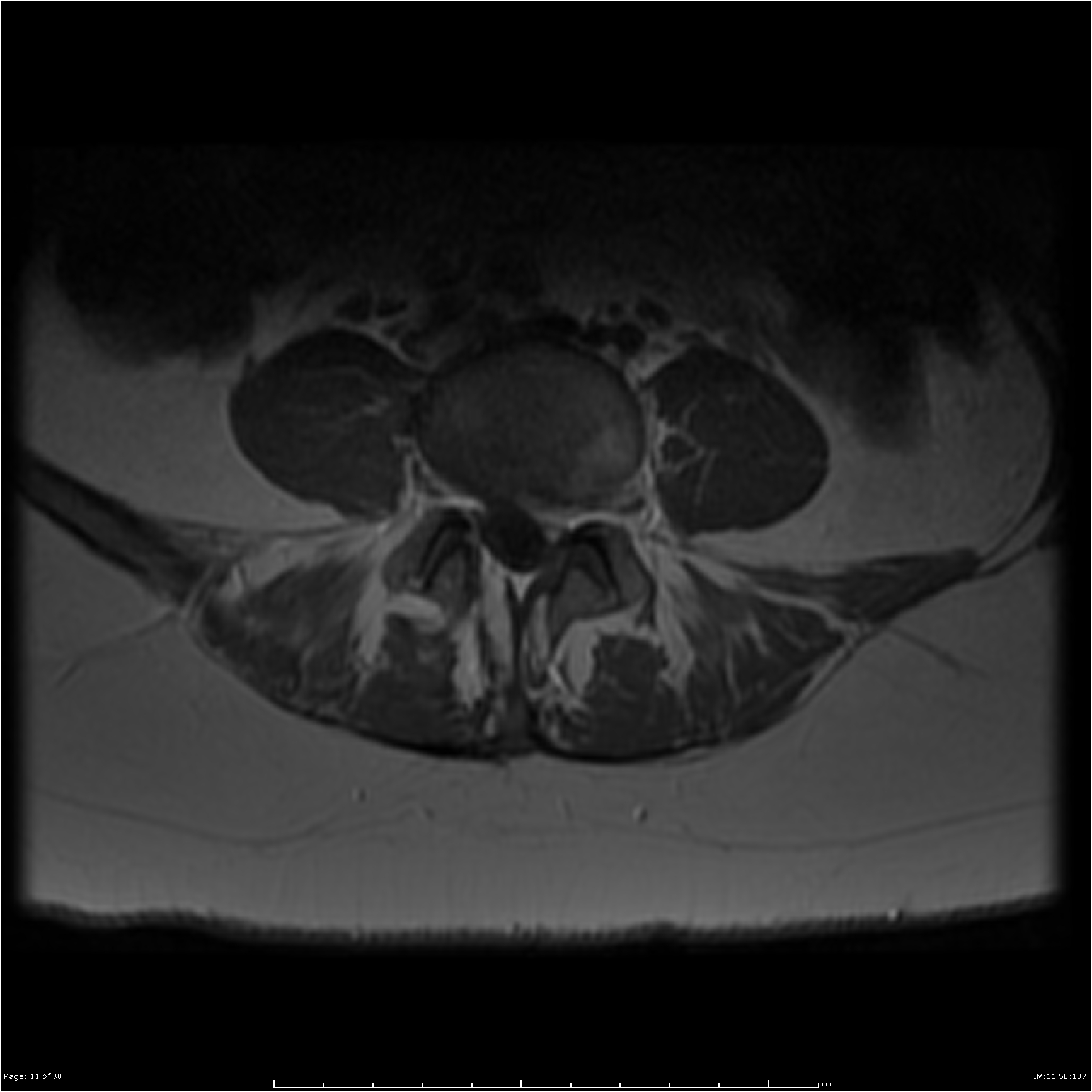 L4/5 left paracentral disc extrusion with left L5 and S1 nerve root ...