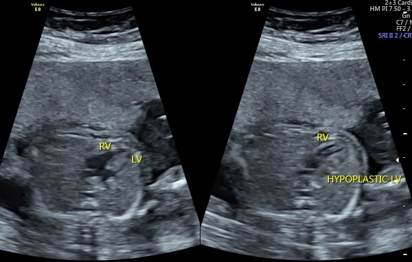 Hypoplastic left heart syndrome - antenatal | Image | Radiopaedia.org