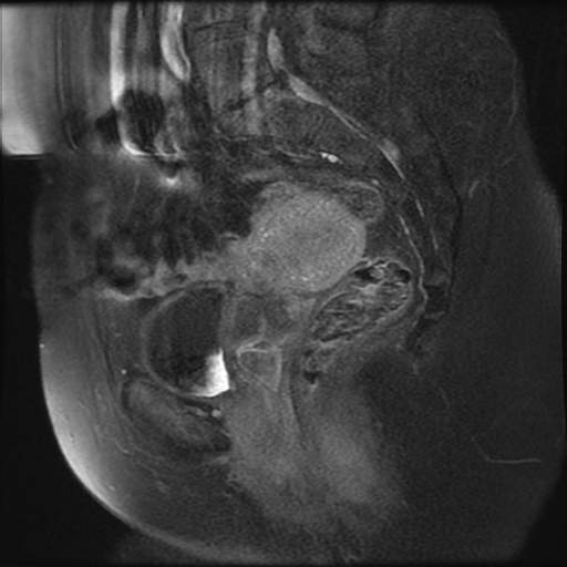 Gartner duct cyst | Image | Radiopaedia.org