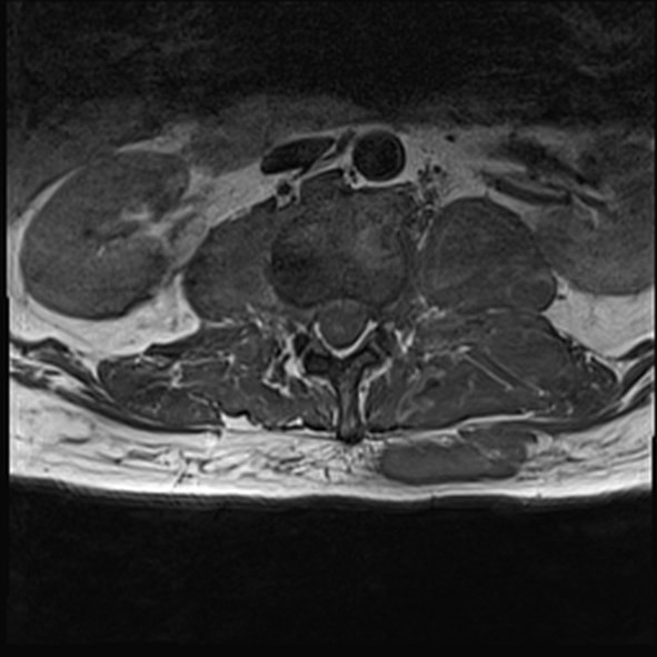 Tuberculous Spondylodiscitis (Pott Disease) | Image | Radiopaedia.org