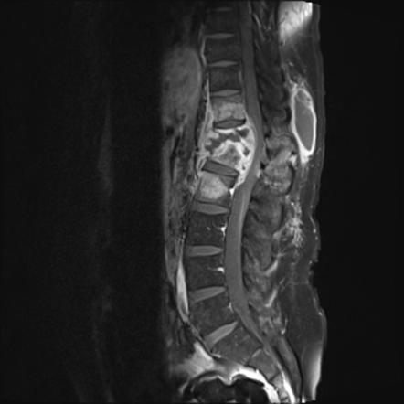 Tuberculous spondylodiscitis (Pott disease) | Radiology Case ...