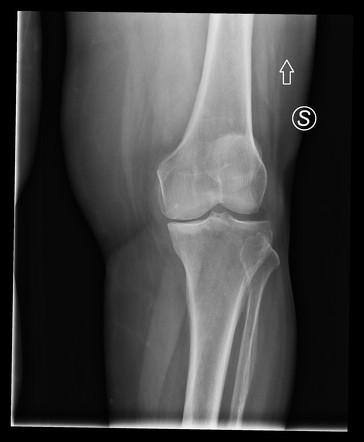 Subchondral insufficiency fracture - knee | Image | Radiopaedia.org