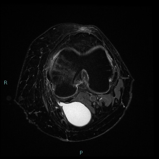 Subchondral Insufficiency Fracture - Knee | Image | Radiopaedia.org