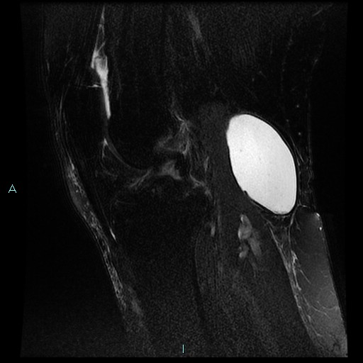 Subchondral Insufficiency Fracture - Knee | Image | Radiopaedia.org