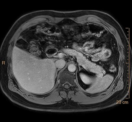 Epiploic Appendagitis 