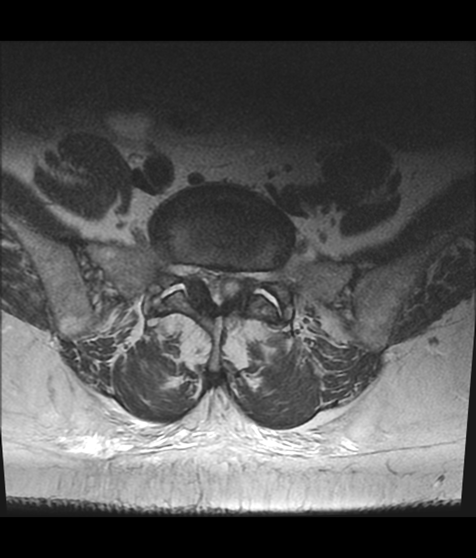 Facet joint synovial cyst | Image | Radiopaedia.org