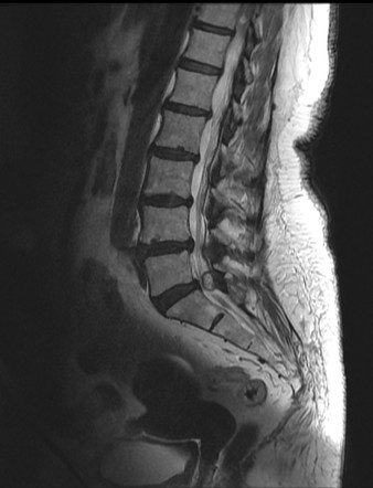 Facet joint synovial cyst | Image | Radiopaedia.org