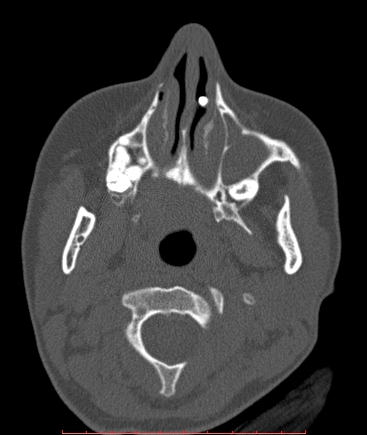 Supernumerary nasal tooth | Image | Radiopaedia.org