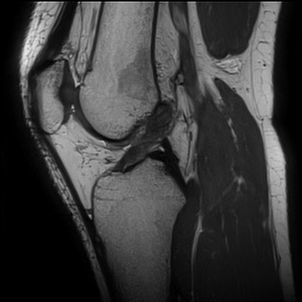 Anterior cruciate ligament rupture and posteromedial corner injury ...