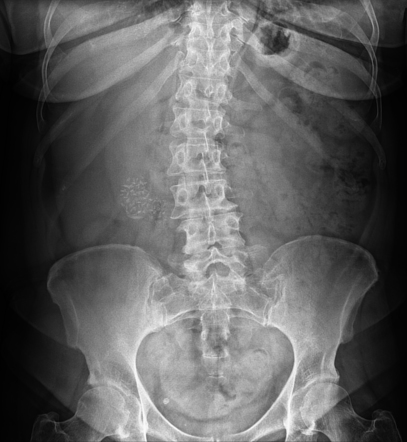 April Fools' | Radiology Reference Article | Radiopaedia.org