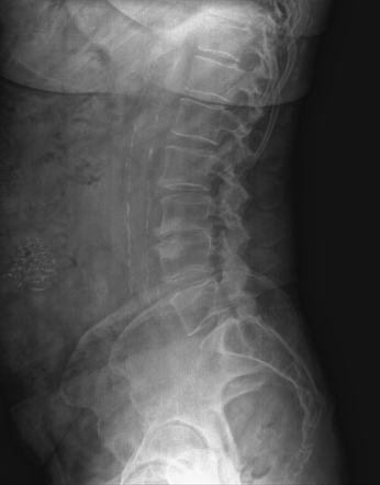 April fools' 2019: calcified peritoneal arachnoidosis | Image ...