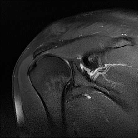 Acromioclavicular injury - Rockwood type III | Image | Radiopaedia.org