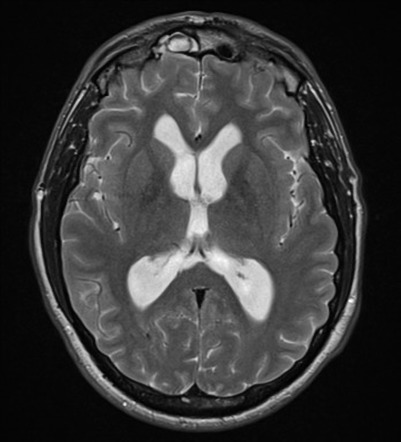 Radiopaedia Mri Brain Anatomy