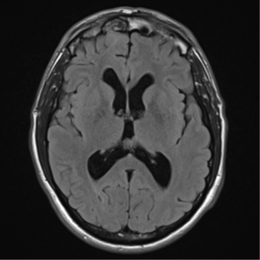 pineal-parenchymal-tumor-of-intermediate-differentiation-image