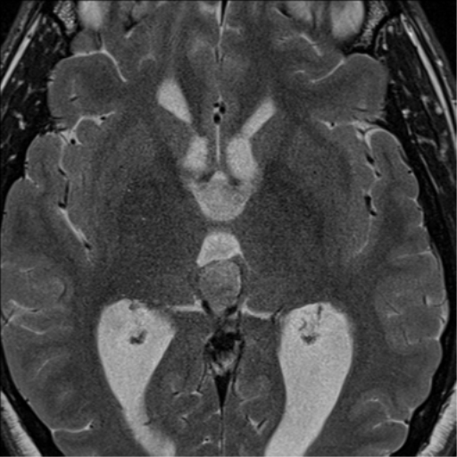 pineal-parenchymal-tumor-of-intermediate-differentiation-image