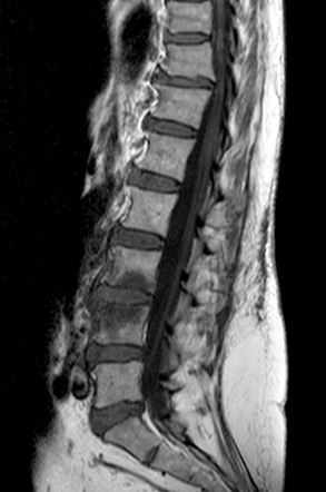 Candida Albicans Spondylitis | Radiology Case | Radiopaedia.org