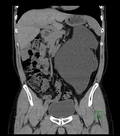 Pelviureteric junction obstruction | Radiology Reference Article ...