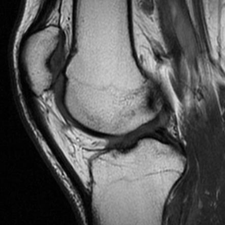 Patella alta | Radiology Reference Article | Radiopaedia.org