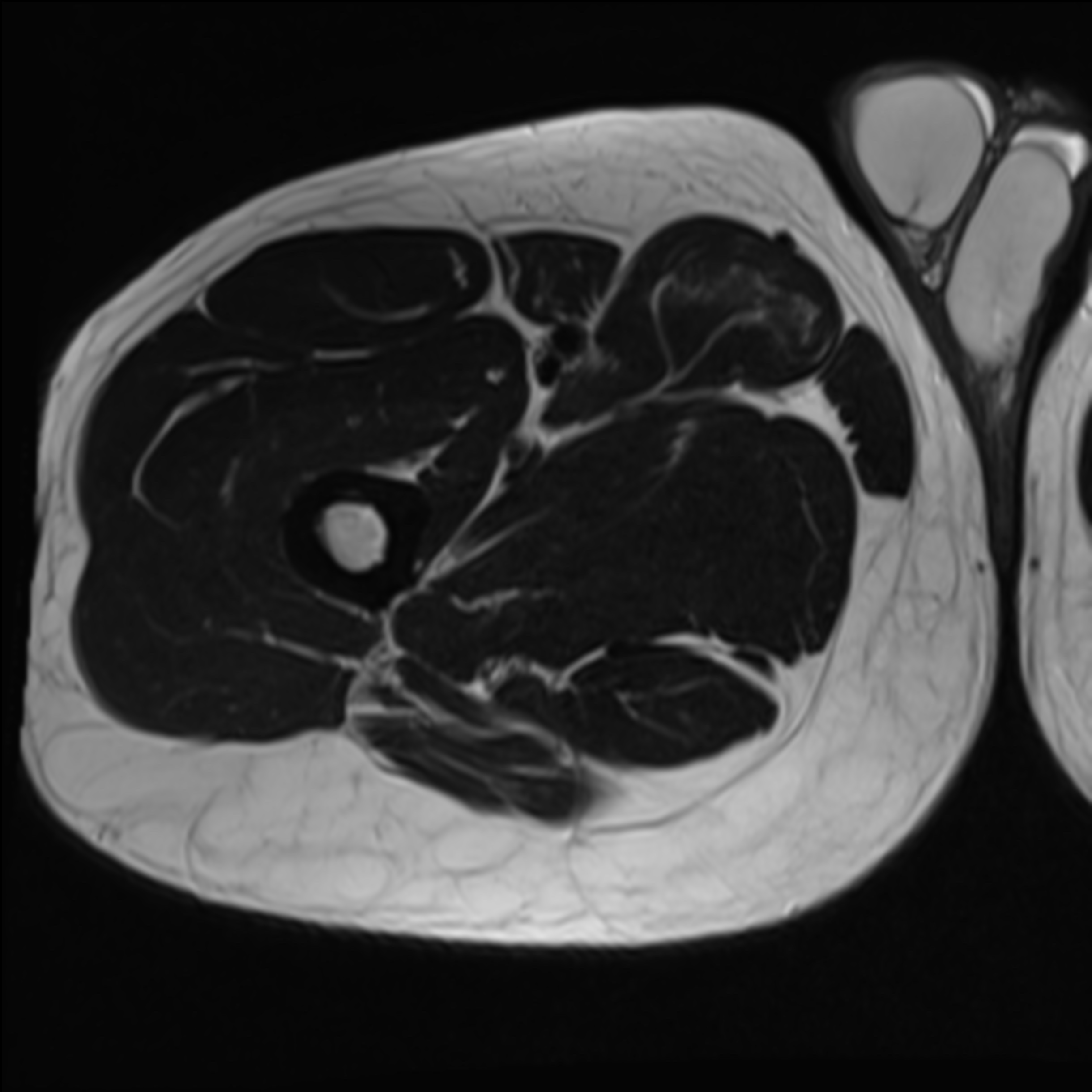 Complete chronic tear of distal adductor longus muscle with pseudomass ...