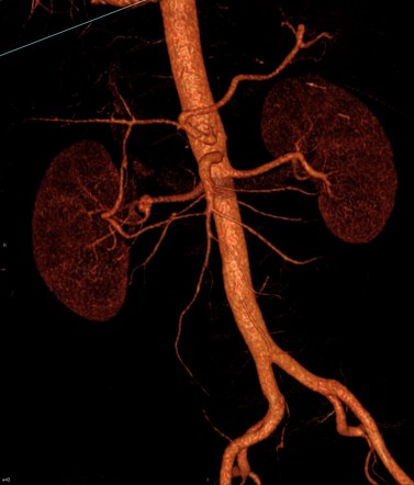 Renal artery aneurysm | Radiology Reference Article | Radiopaedia.org