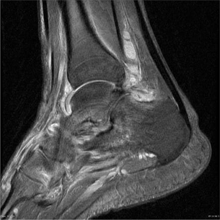 Viewing playlist: MRI Ankle | Radiopaedia.org