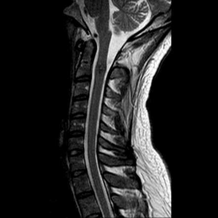 Spinal cord cavernous malformation | Radiology Case | Radiopaedia.org