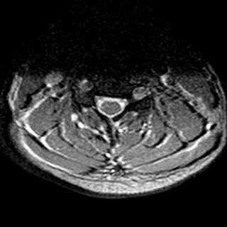 Spinal cord cavernous malformation | Image | Radiopaedia.org