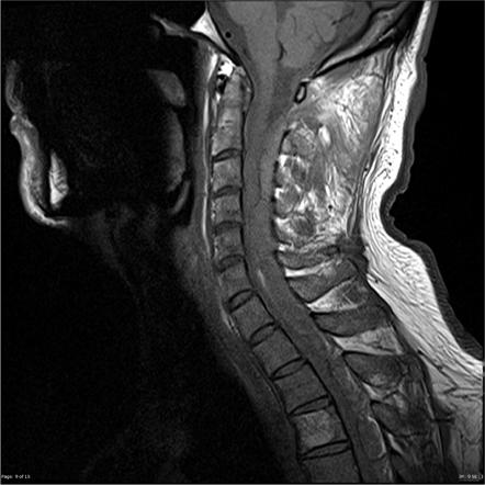 Spinal epidural hematoma | Image | Radiopaedia.org