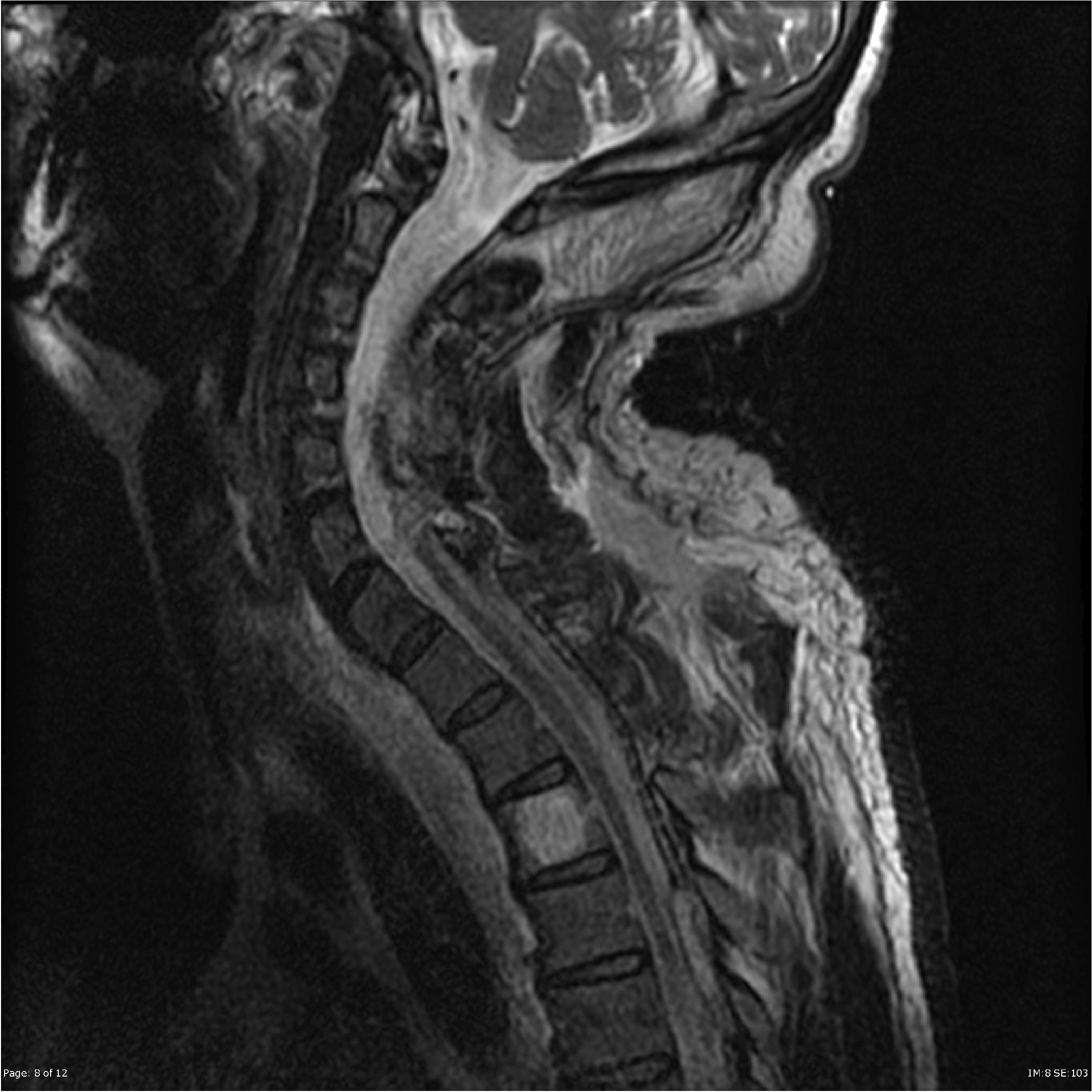 Epidural Hematoma Radiology