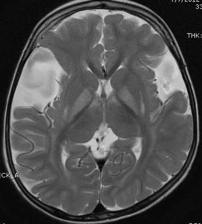 Glutaric Aciduria Type I Radiology Case Radiopaedia Org   77e572b5bae6a54bbba86183b33a3e Gallery 