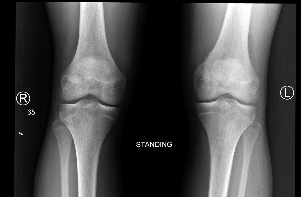 Cortical Desmoid Radiology Case Radiopaedia Org