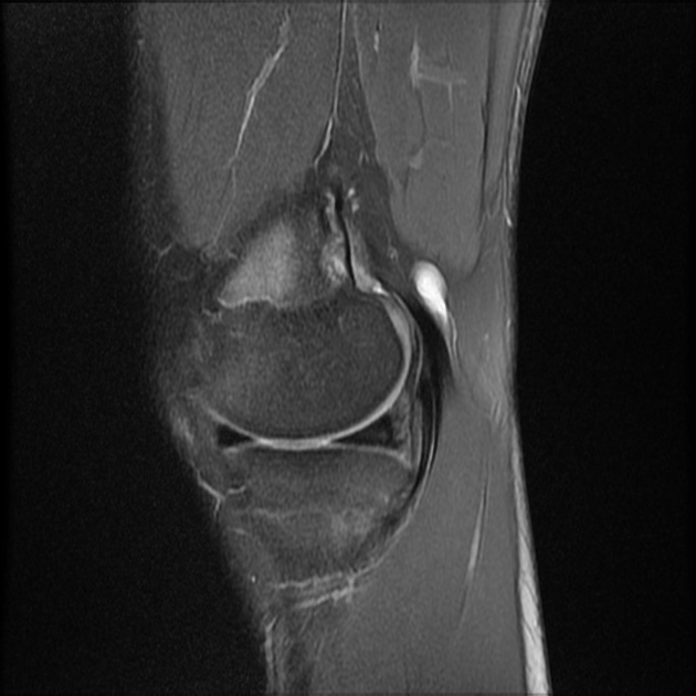 Cortical Desmoid Radiology Case Radiopaedia Org