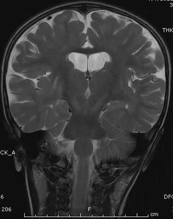 Glutaric Aciduria Type I Image Radiopaedia Org   Ad8ae7040e9e9065bdb62e04e14548 Gallery 