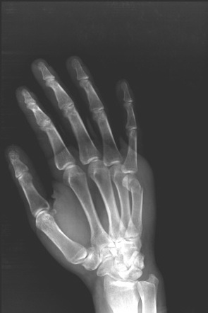 Boxer fracture | Image | Radiopaedia.org