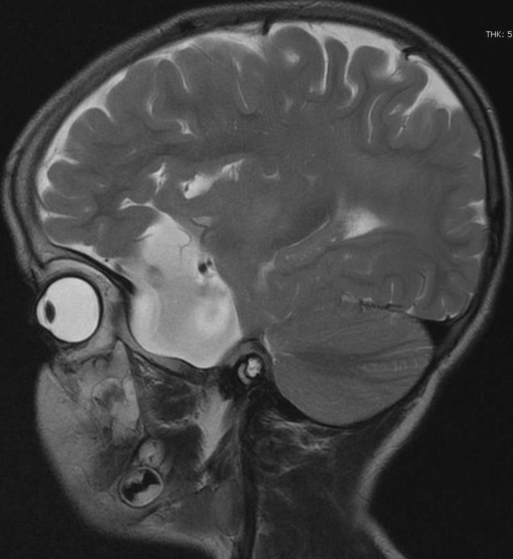 Glutaric Aciduria Type I Image Radiopaedia Org   31793e343570f6f20e028e1ad79337 