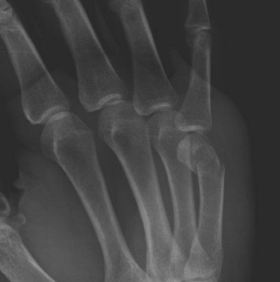 Boxer fracture Image