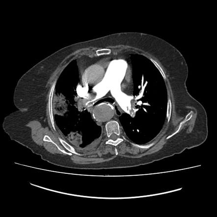 Pulmonary embolism with lung infarct and incidental Kommerell ...