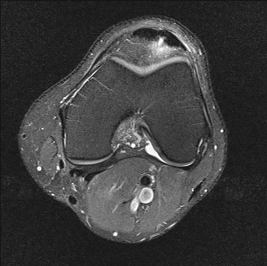 Jumper's knee | Image | Radiopaedia.org