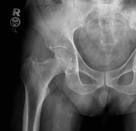 Phemister triad (tuberculosis) | Radiology Reference Article ...