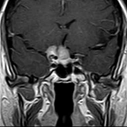 Planum sphenoidale meningioma with extension to optic nerve | Image ...