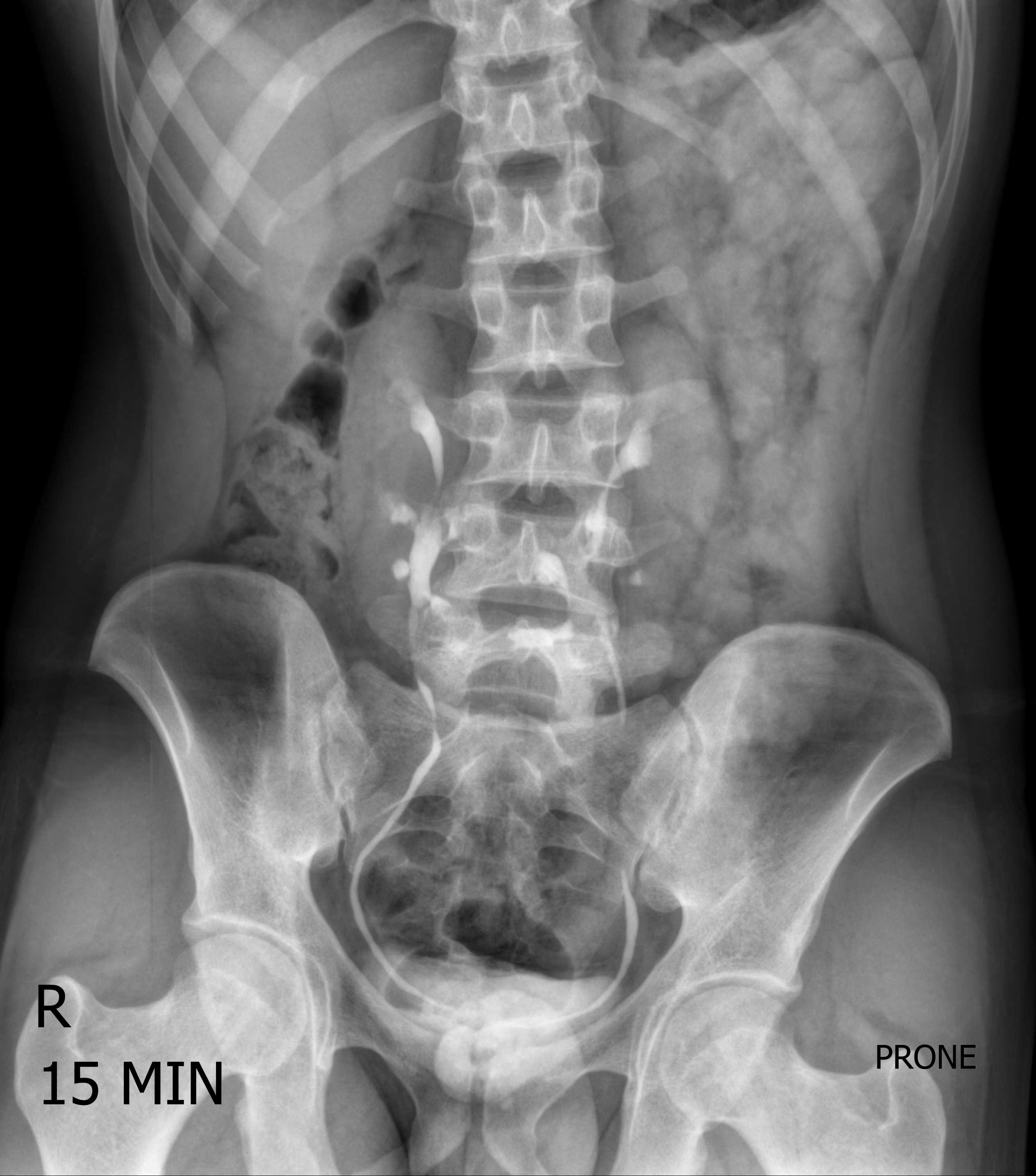 Horseshoe kidney IVU Image