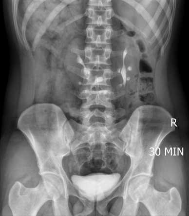 Horseshoe kidney - IVU | Image | Radiopaedia.org