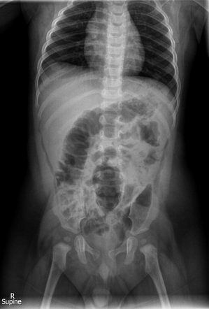 Properitoneal fat mimicking intraperitoneal air | Radiology Case ...