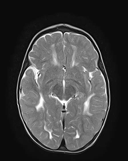 Vanishing white matter disease | Image | Radiopaedia.org