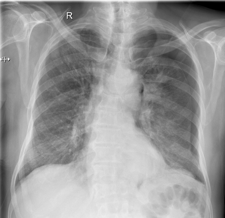 Left sided pneumothorax with left lung mass | Radiology Case ...