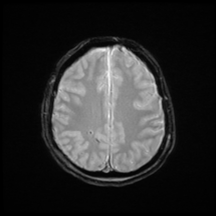 Diffuse axonal injury (DAI) | Image | Radiopaedia.org