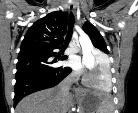 Congenital Pulmonary Agenesis 