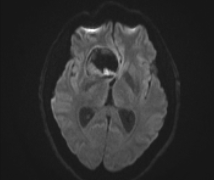 Intracranial Dermoid Cyst Ruptured Image 4706